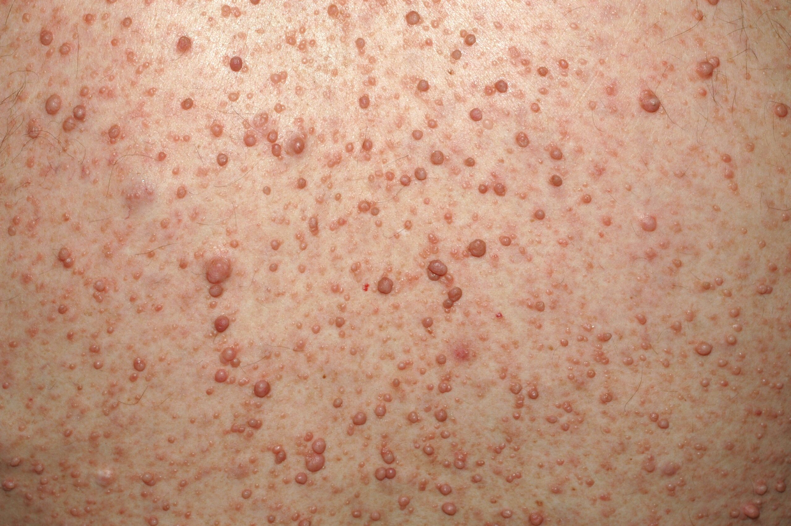 Neurofibromatosis Q85.00; manchas café con leche aisladas y neurofibromas múltiples (1)