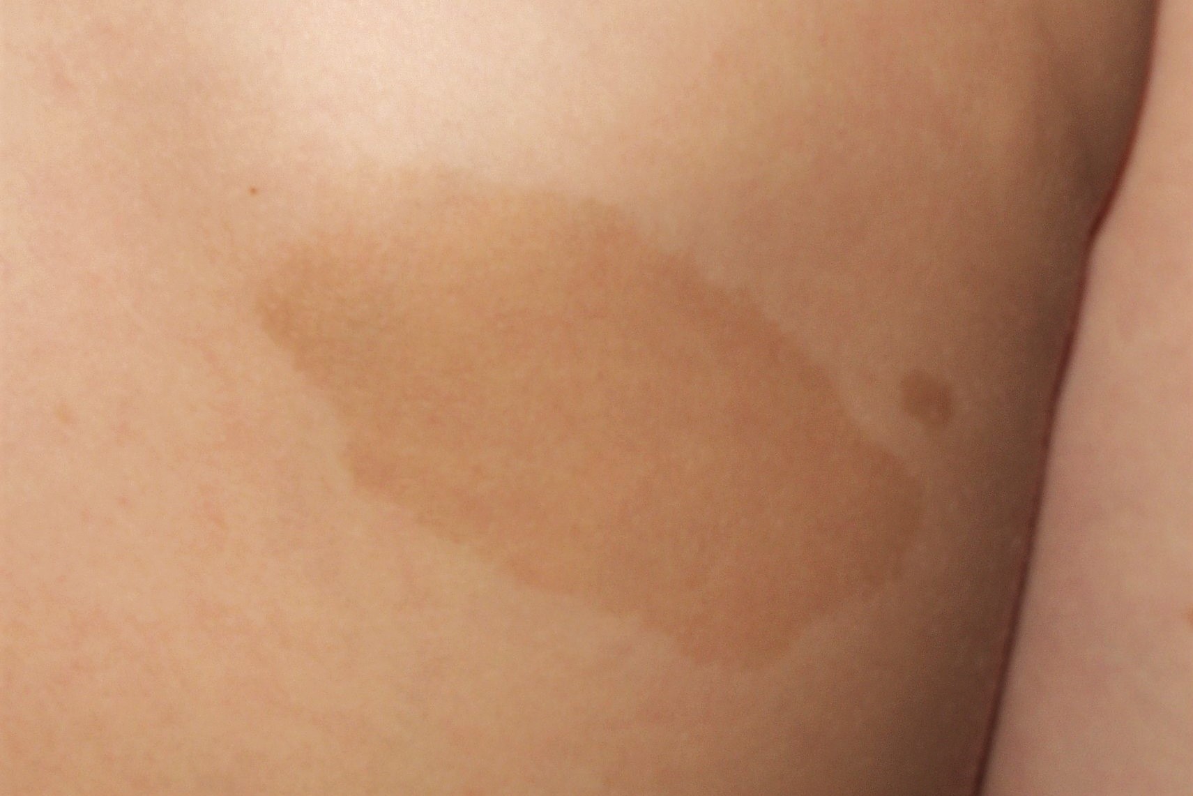 Neurofibromatosis Q85.00; manchas café con leche (1)