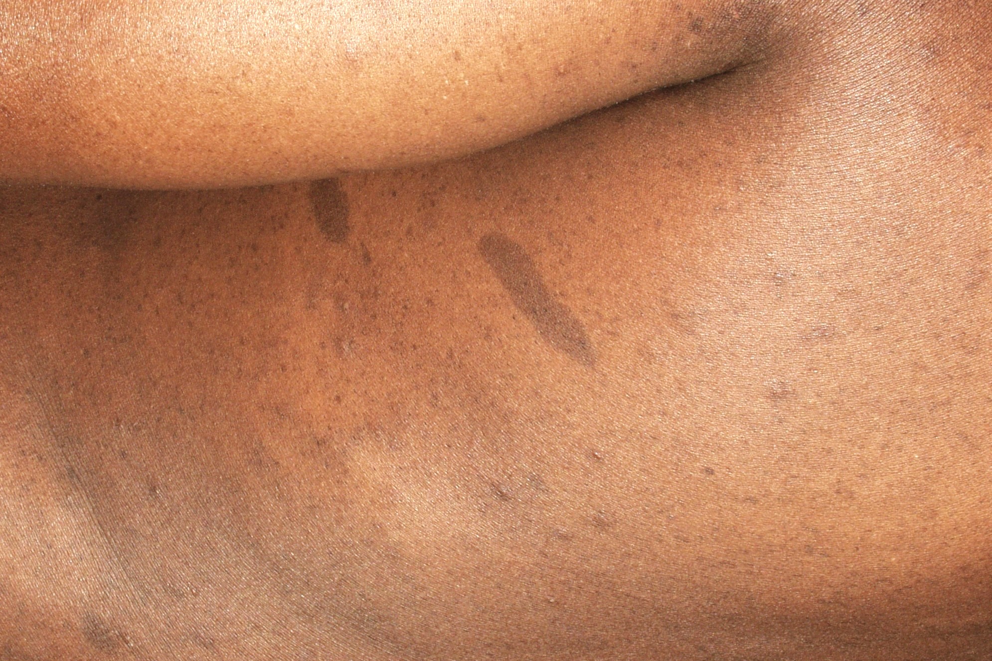 Neurofibromatosis Q85.00; manchas café con leche y lentiginosis (2)