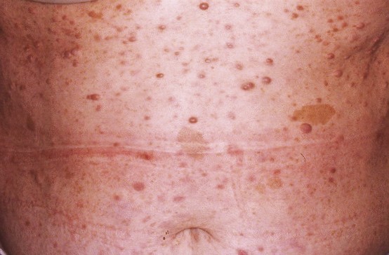 Neurofibromatosis Q85.00; manchas café con leche y neurofibromas (1)