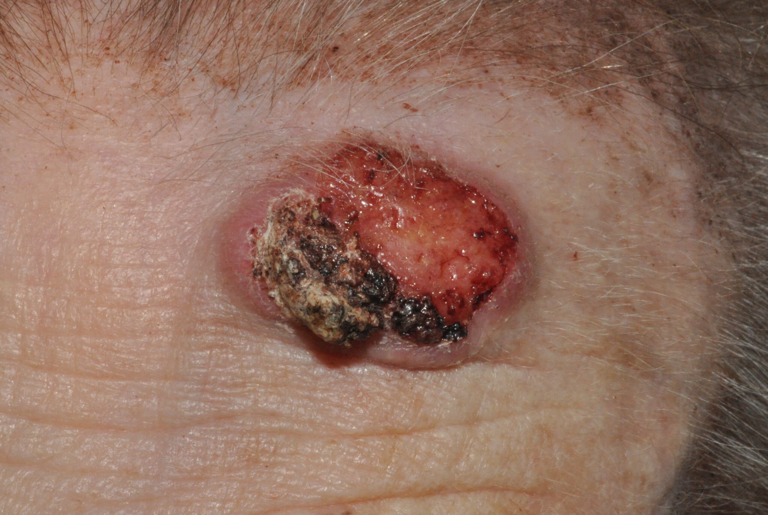C44.92 003 Carcinoma escamoso de la frente; nódulo ulcerado y costroso de 27x16 mm y un año de evolución