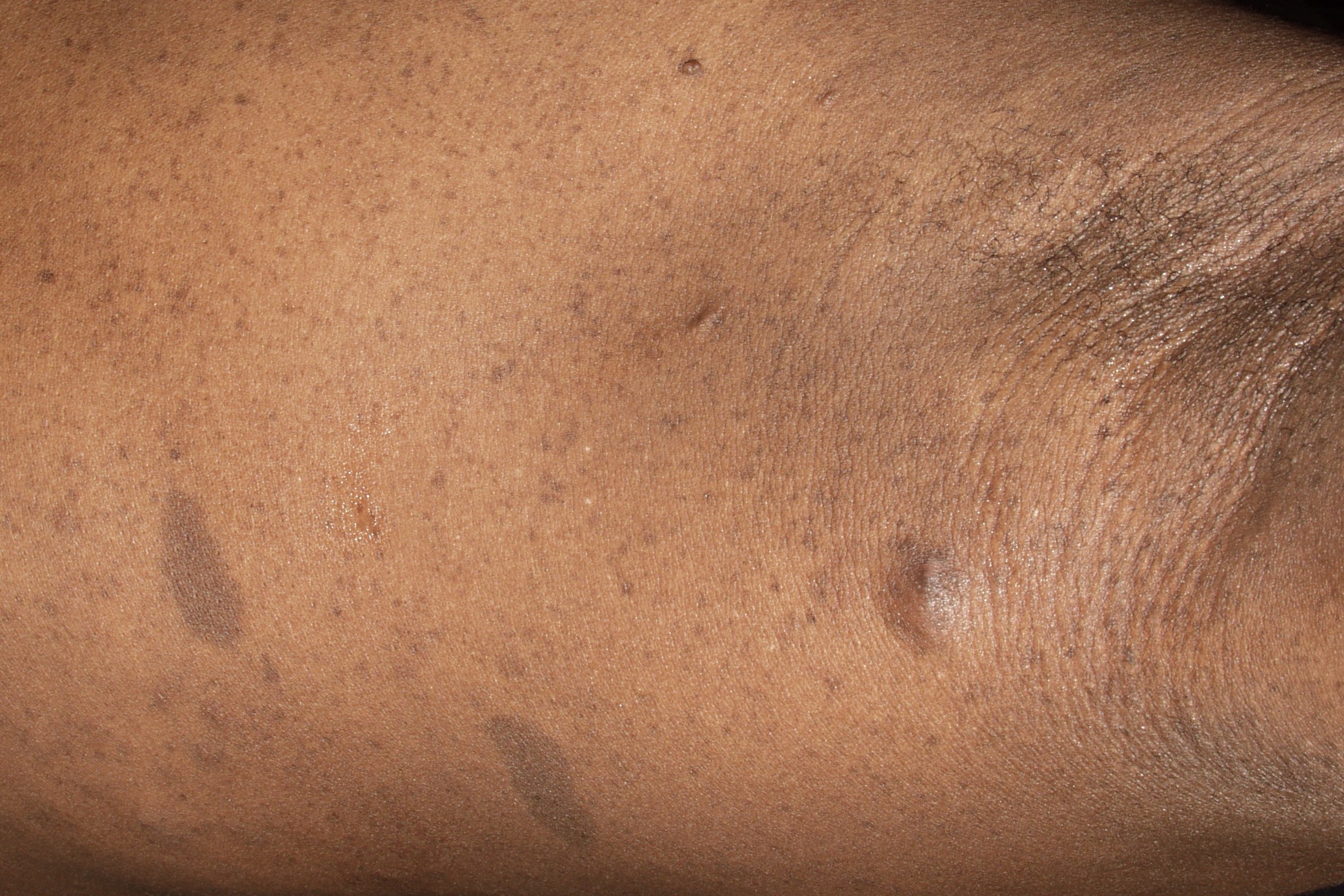 Neurofibromatosis Q85.00; manchas café con leche y signo de Crowe (pecas axilares) (1)