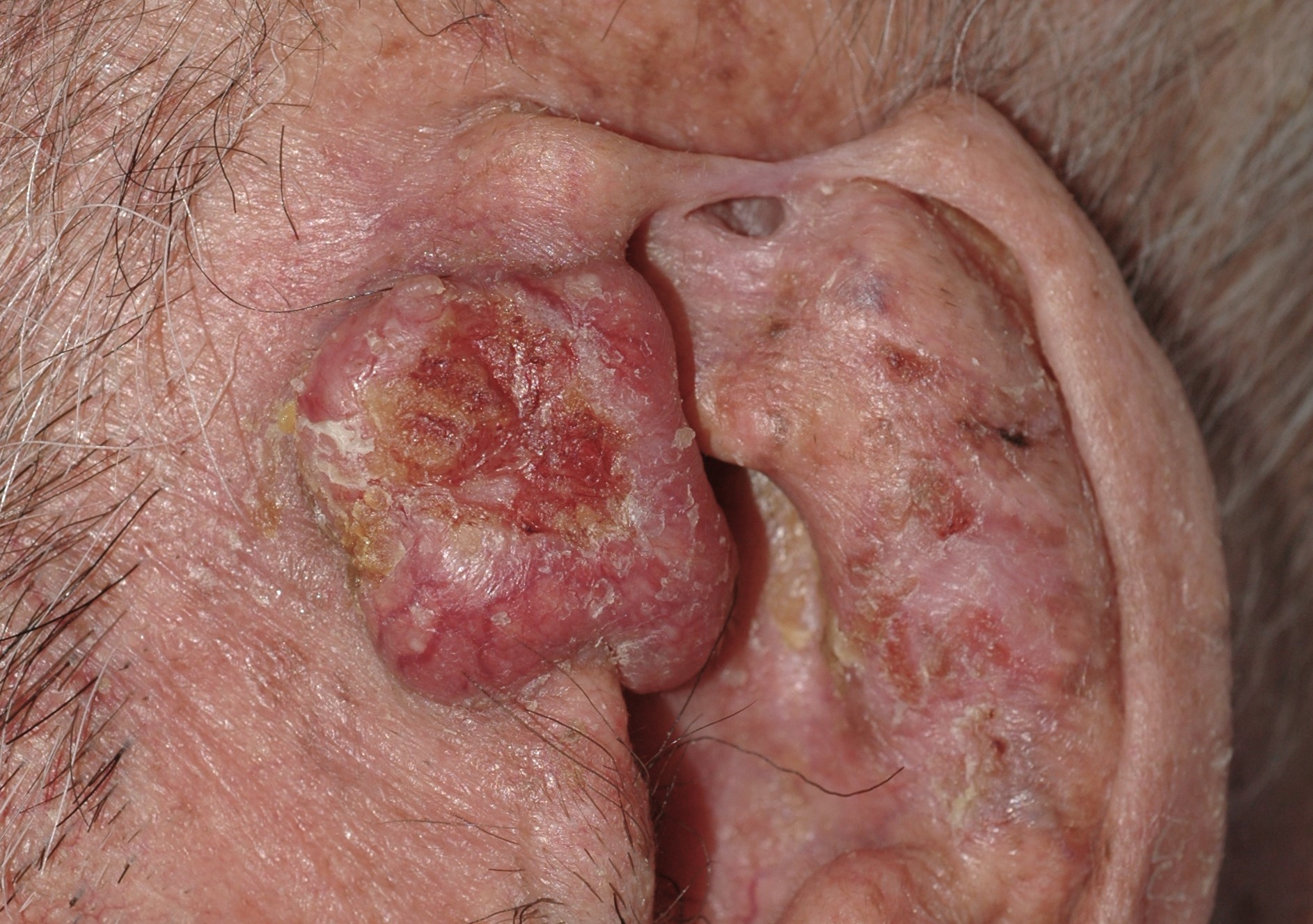 C44.92 006 Carcinoma escamoso cutáneo; nódulo indurado y ulcerado de localización preauricular. Paciente de 83 años, evolución 1 año
