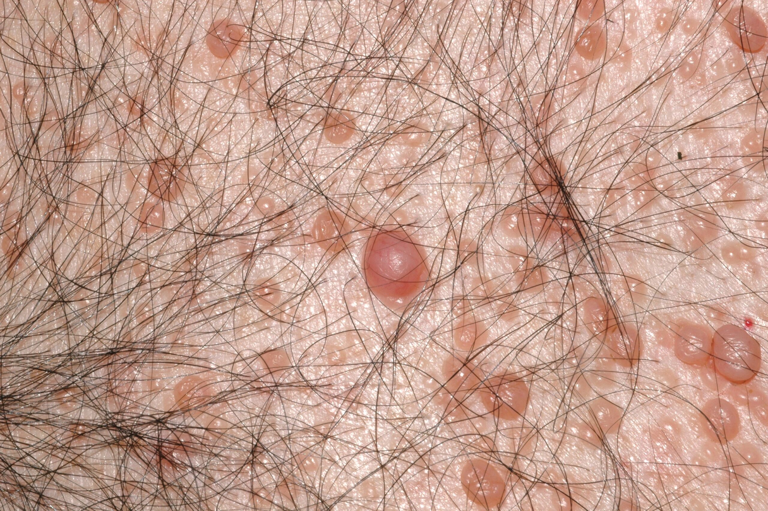Neurofibromatosis Q85.00; múltiples neurofibromas cutáneos (2)