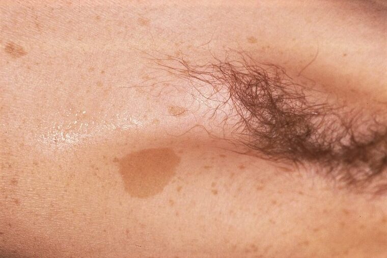 Neurofibromatosis Q85.00; signo de Crowe, pecas axilares (y manchas café con leche) (1)