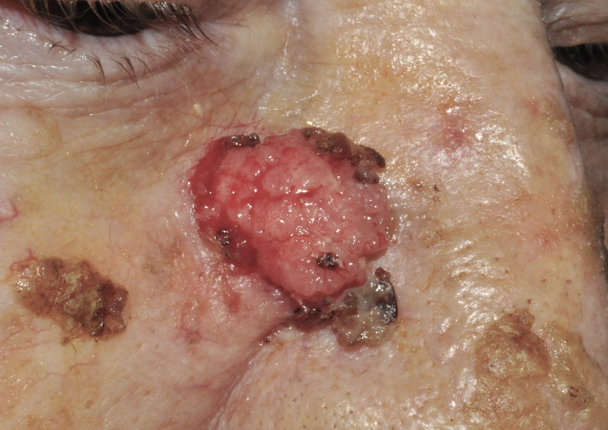 Carcinoma escamoso de la cara C44.92; nódulo ulcerado y friable