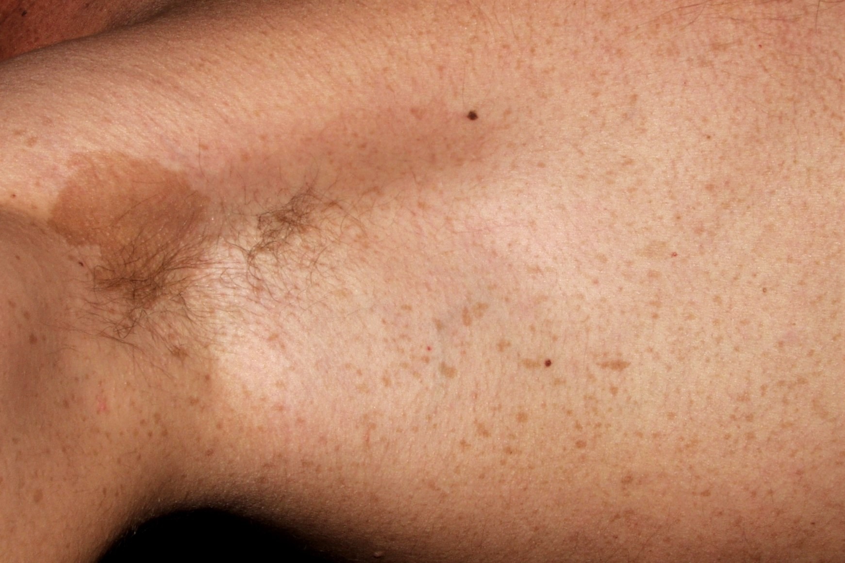 Neurofibromatosis segmentaria Q85.00; neurofibromatosis en mosaico; signo de Crowe, pecas axilares (y manchas café con leche) (2)