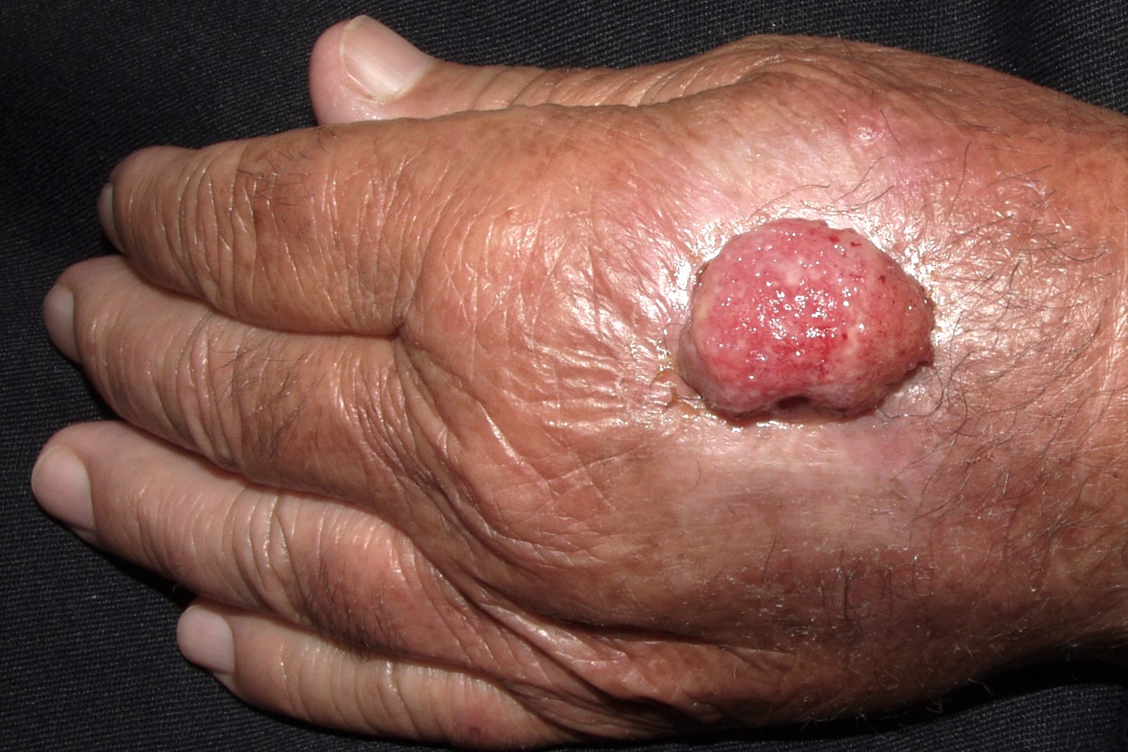 Carcinoma escamoso del dorso de la mano C44.62; nódulo ulcerado y friable de 19x17 mm