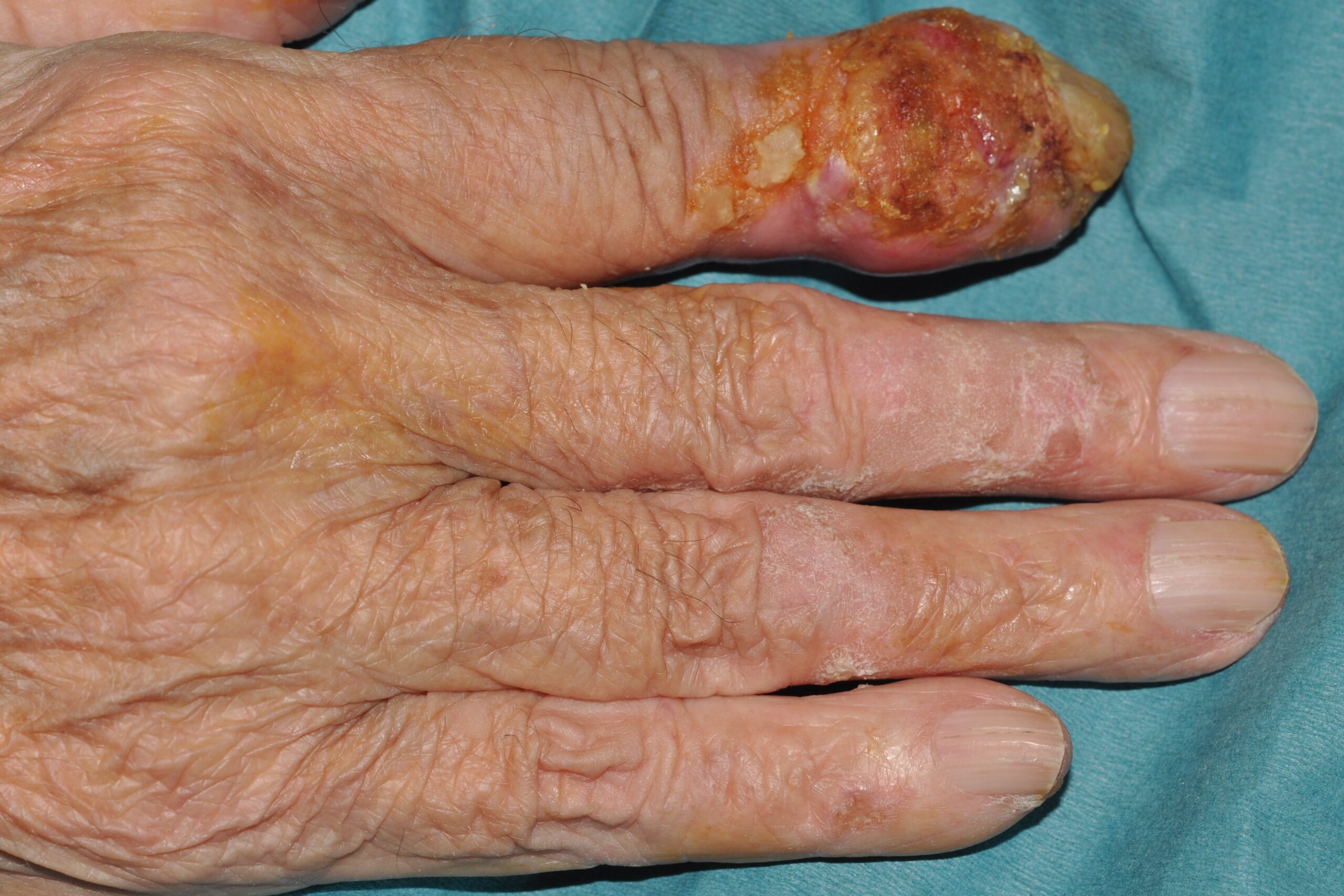 Carcinoma escamoso de la punta del dedo índice sobre radiodermitis crónica C44.62; nódulo indurado, ulcerado y costroso