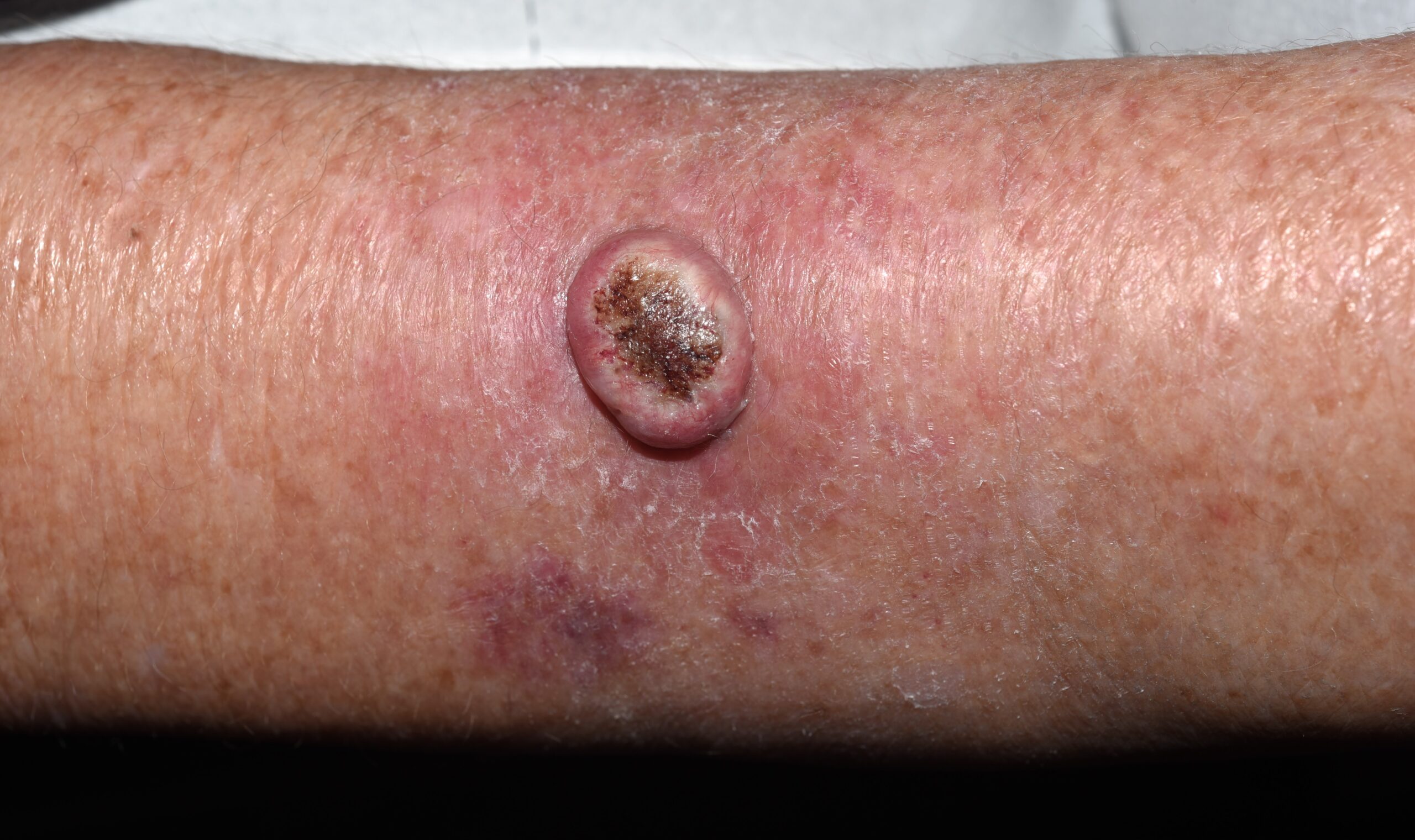 Carcinoma escamoso de la pierna C44.92; nódulo ulcerado y friable en la pierna en una mujer1 (2)