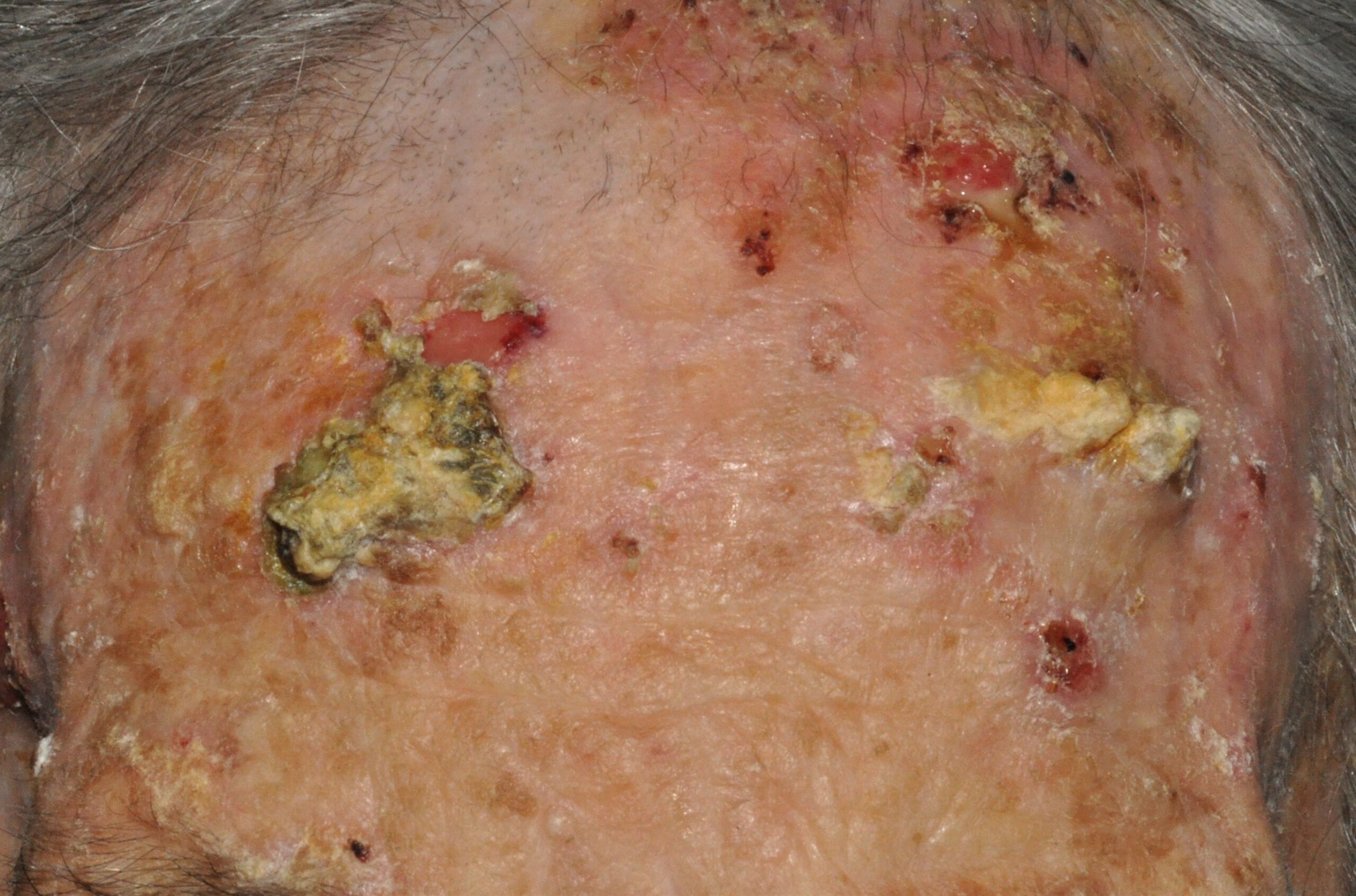 C44.92 004 Carcinomas escamosos múltiples; nódulos queratósicos en frente. 87 años, 2 años de evolución
