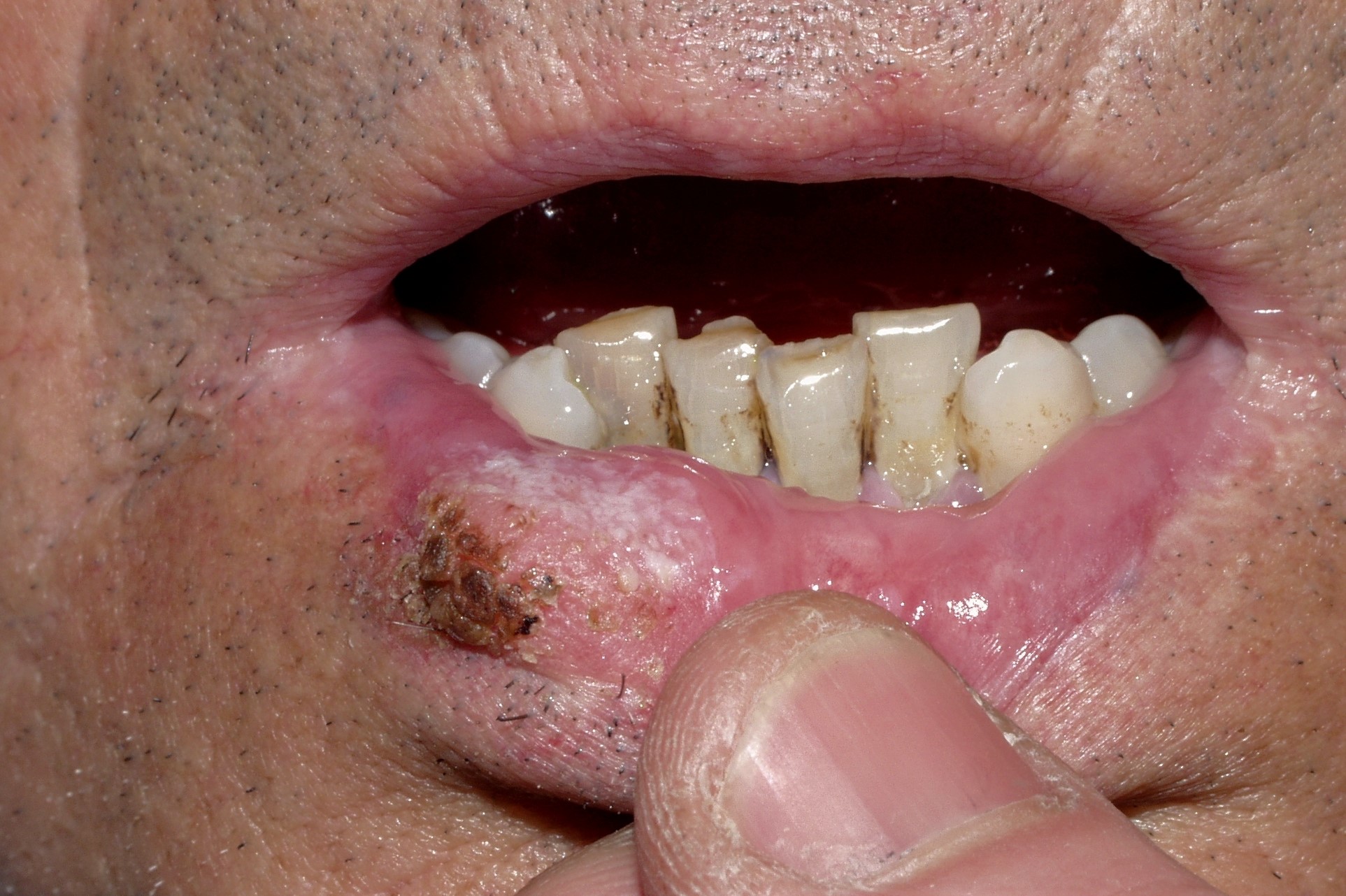 Carcinoma escamoso del labio C00.2. placa descamativa y costrosa indurada y ulcerada