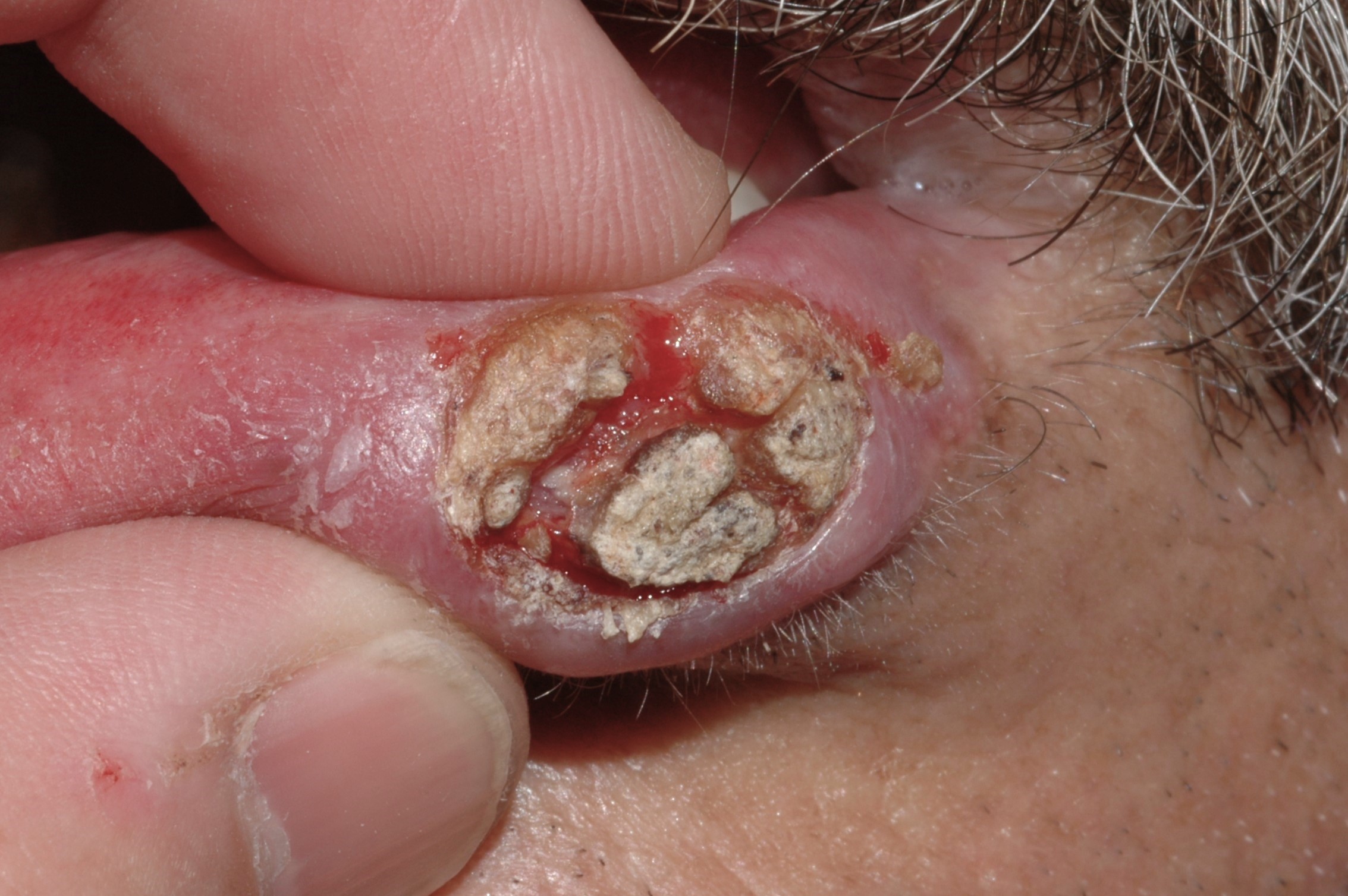 Carcinoma escamoso del labio C00.1; nódulo ulcerado e indurado (1)