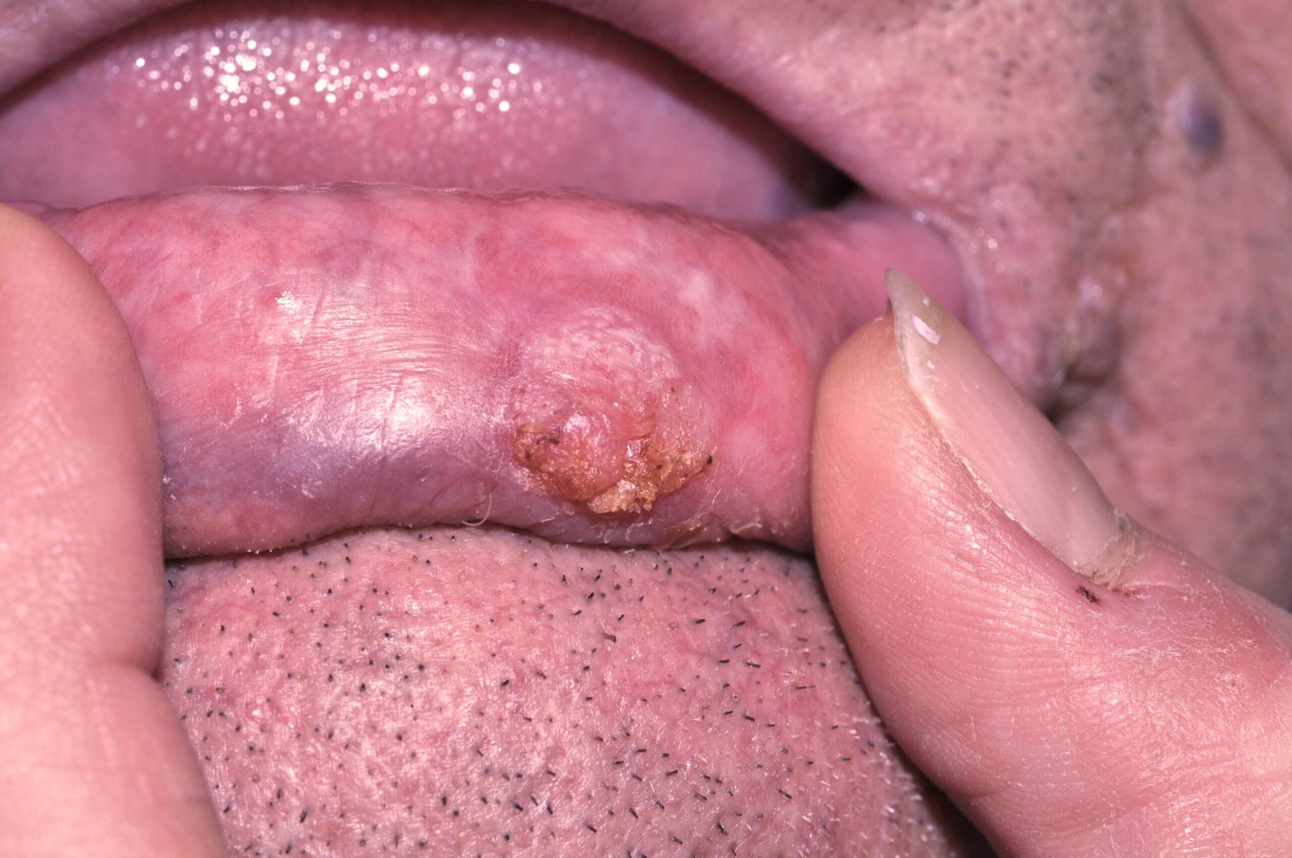 Carcinoma escamoso del labio C00.2. placa descamativa y costrosa indurada y ulcerada (2)