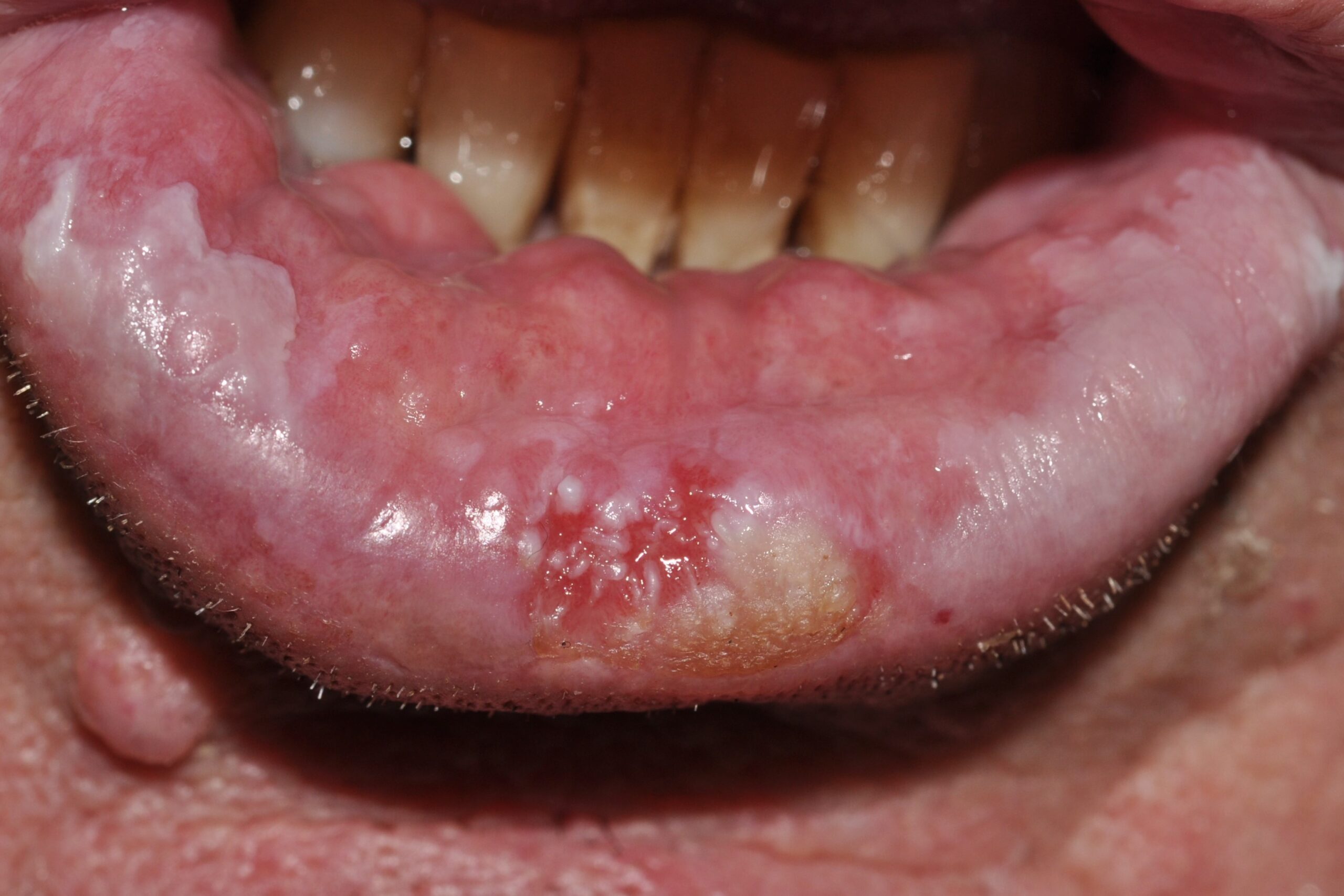 Carcinoma escamoso del labio C00.2. placa  indurada y ulcerada sobre leucoplasia (1)