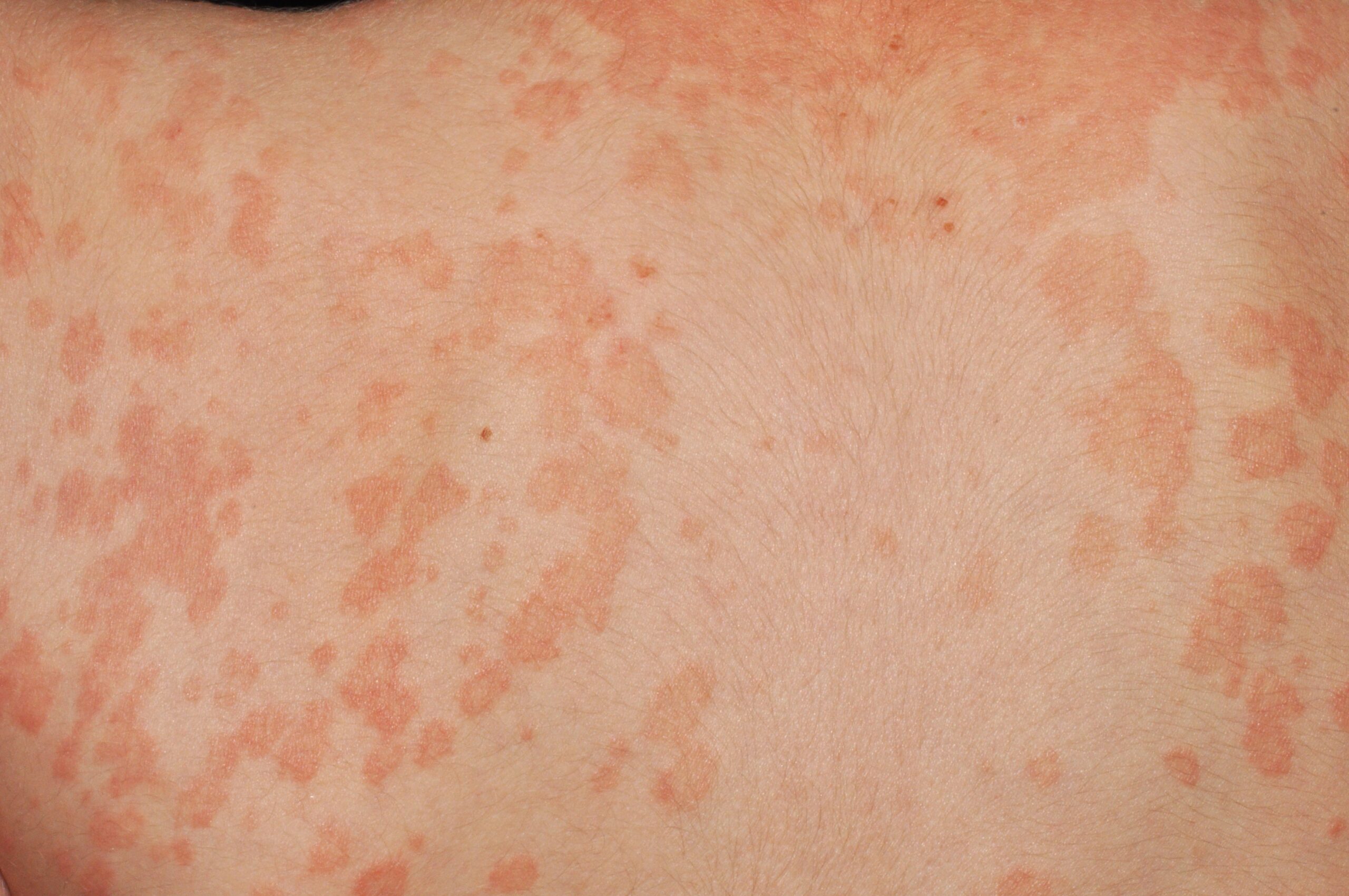 Pitiriasis versicolor parda B36.0; máculas hiperpigmentadas; localización parte superior de espalda (3)