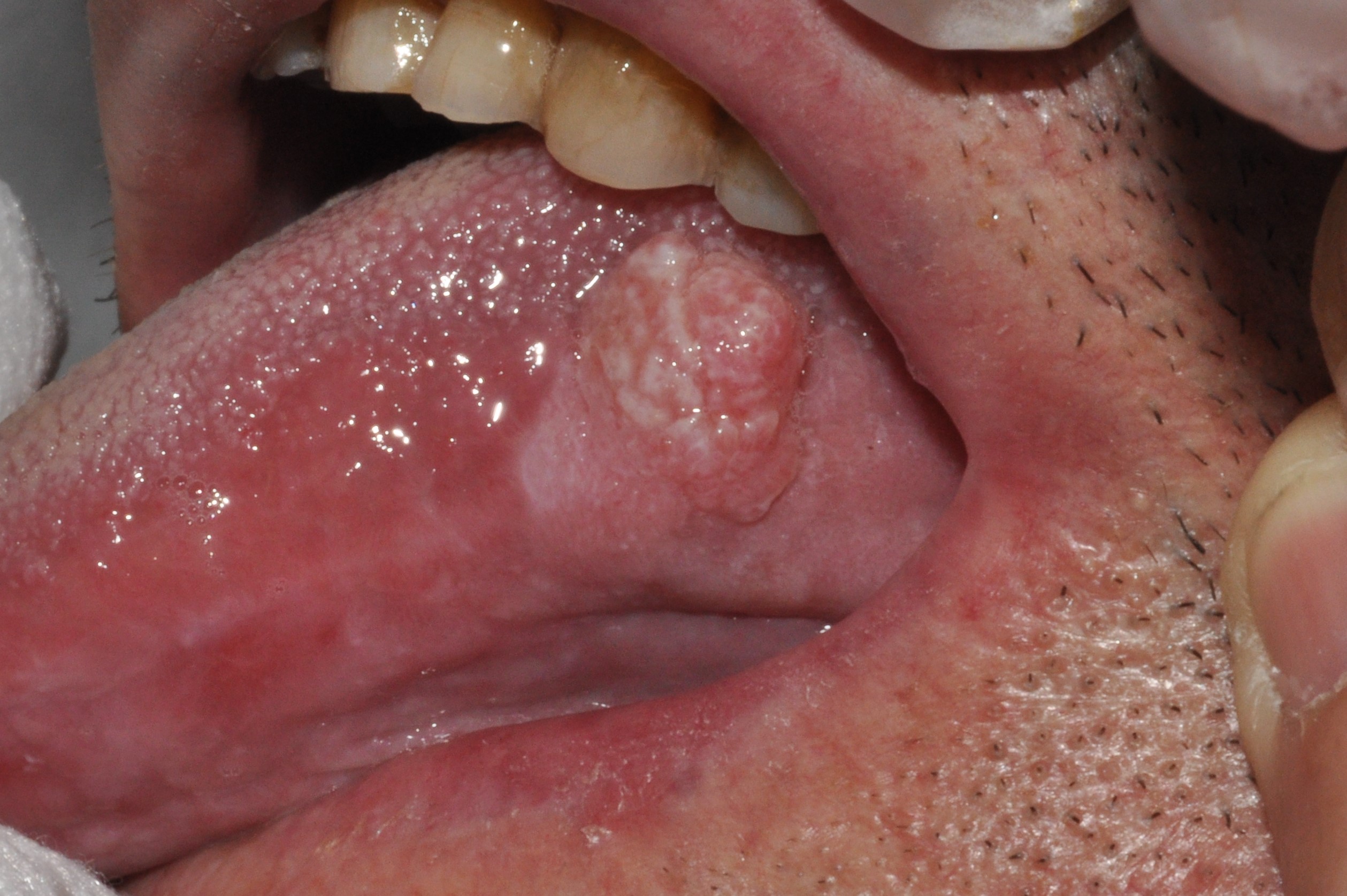 Carcinoma escamoso de la lengua C02.09; nódulo ulcerado e indurado en cara laeral del tercio posterior de la lengua (2)