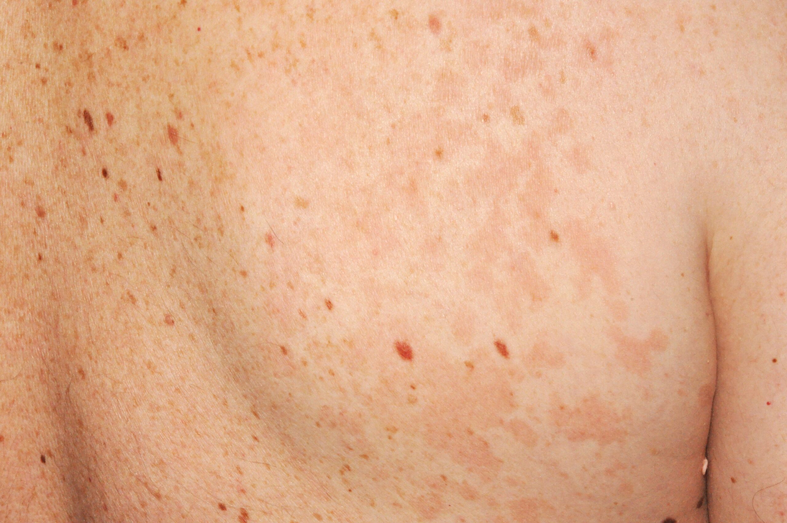Pitiriasis versicolor parda B36.0; máculas hiperpigmentadas; localización parte superiro del tronco (7)