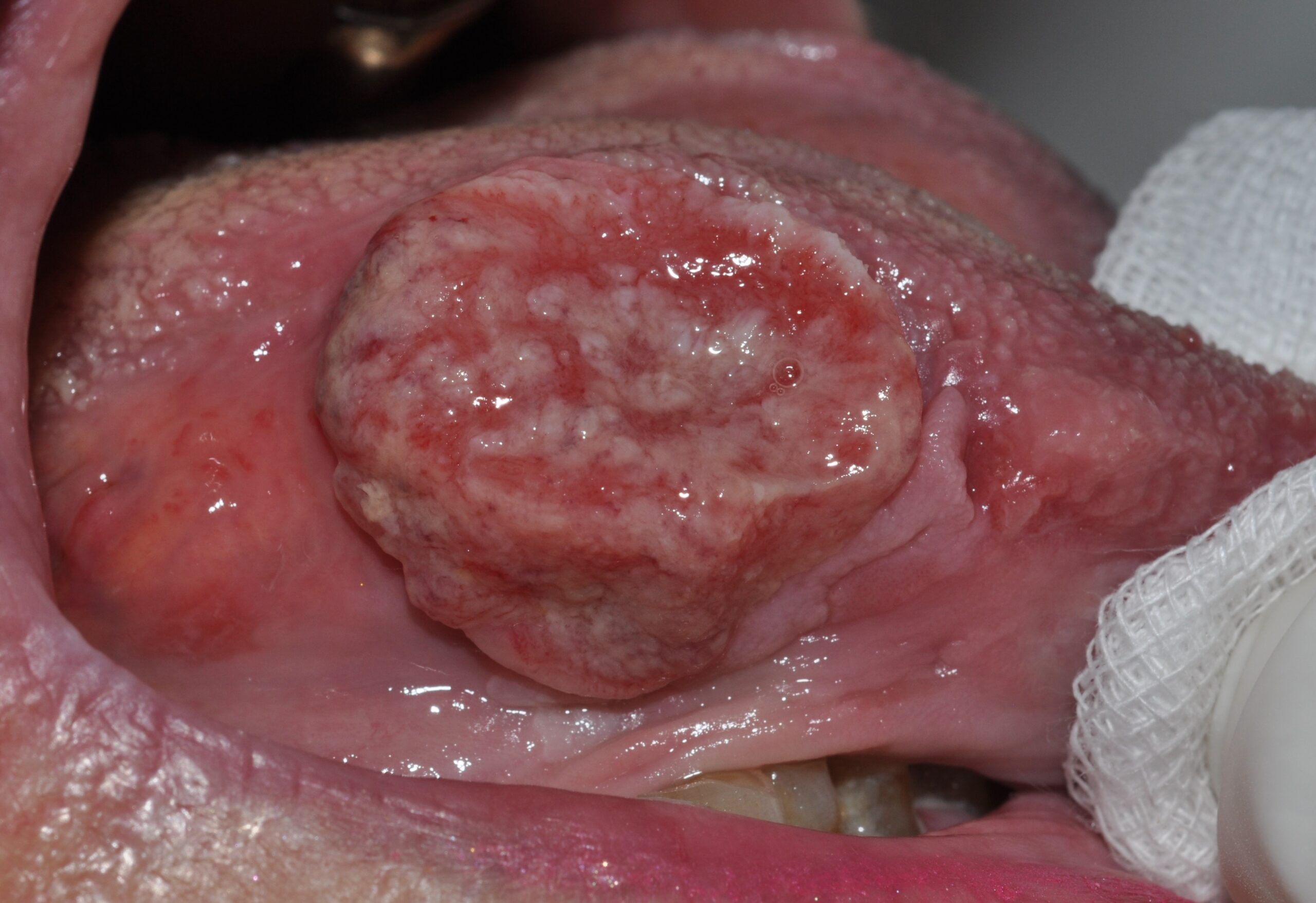 Carcinoma escamoso de la lengua C02.9; nódulo ulcerado e indurado en la cara lateral y posterior de la lengua sobre placa de leucoplasia