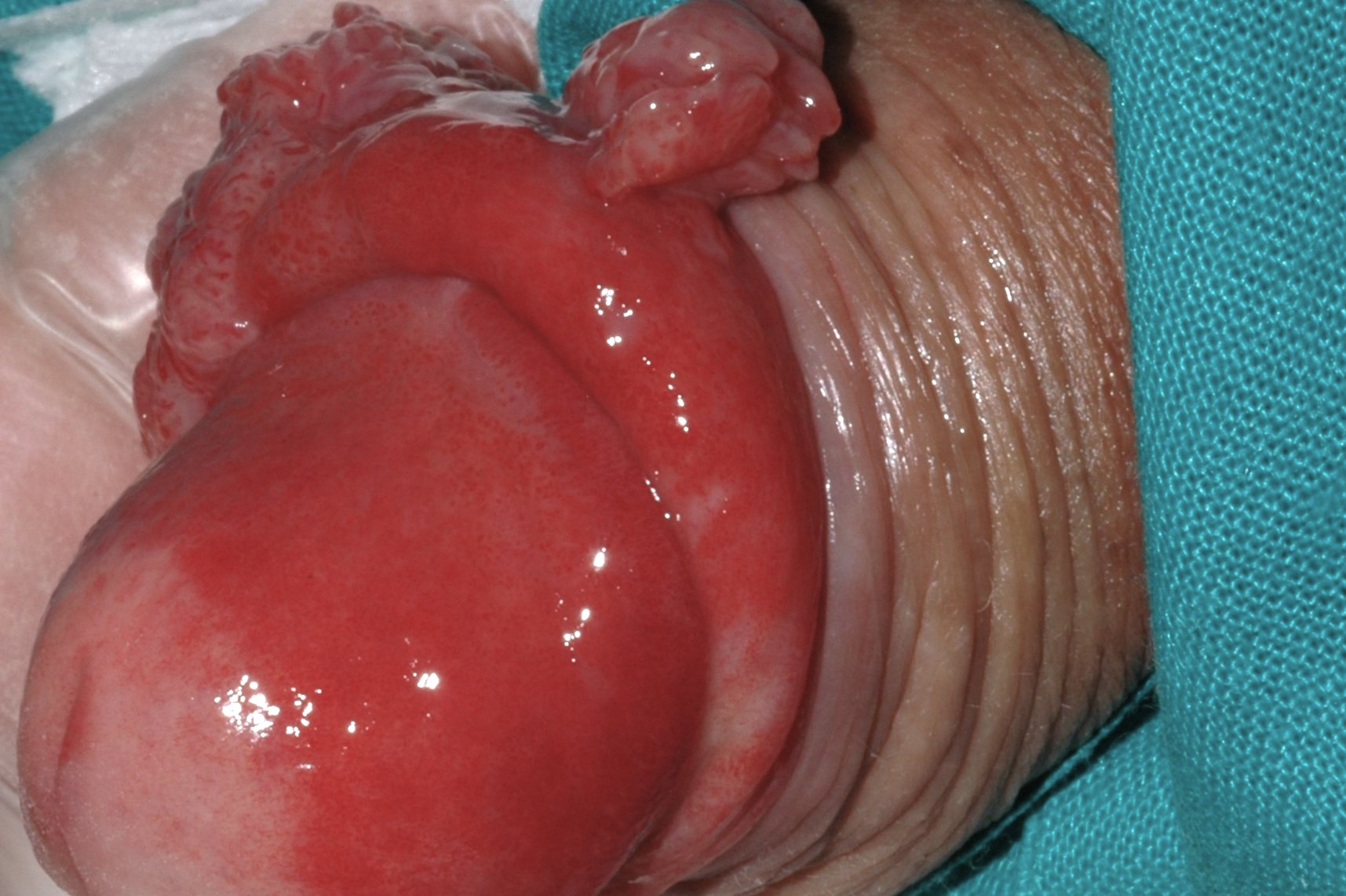 Carcinoma escamoso de pene sobre eritroplasia de Queyrat C60.9; nódulo eritematoso verrugoso en glande (1)