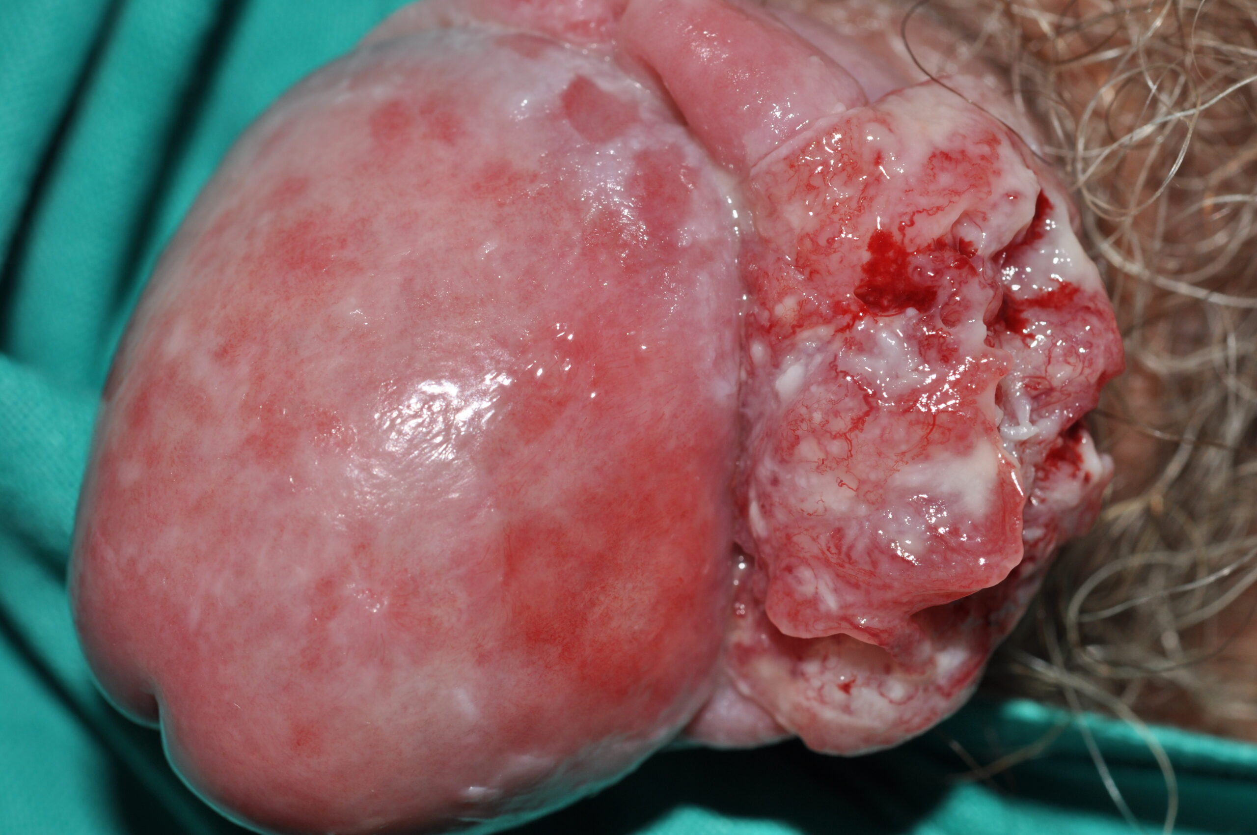 Carcinoma escamoso de pene sobre placa de liquen escleroatrófico  C60.9; nódulo indurado, ulcerado y verrugoso (1)