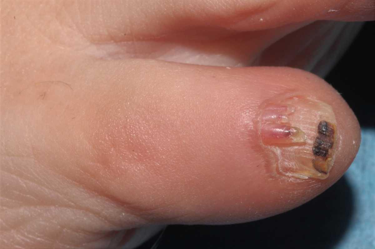 Tumor de Koenen solitario; fibroma periungueal
