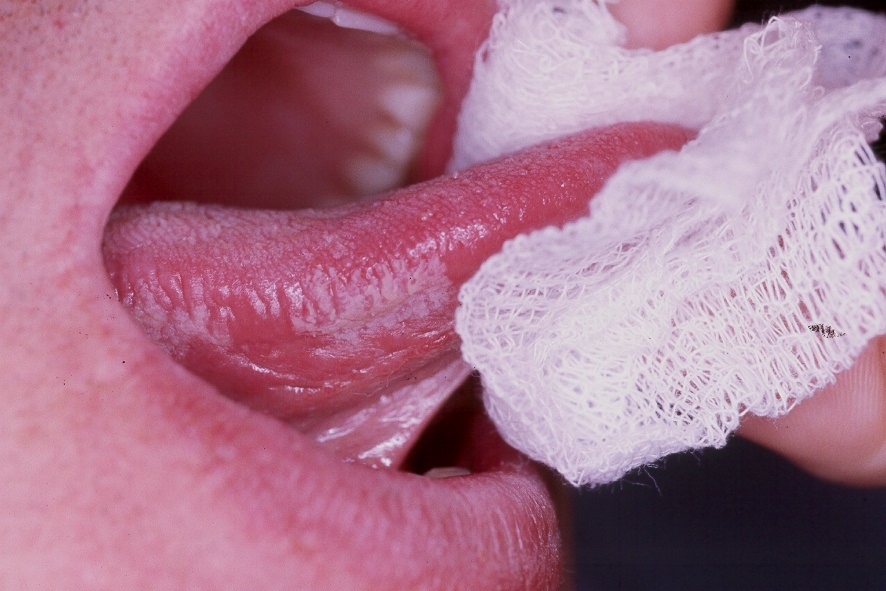 Fig 9.5. Leucoplasia oral pilosa